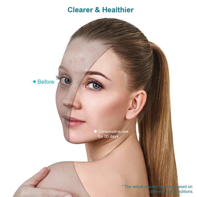 قناع علاج حب الشباب بالضوء الأزرق والأحمر من Xpreen